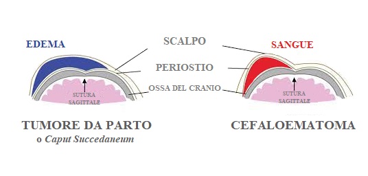 tumore da parto